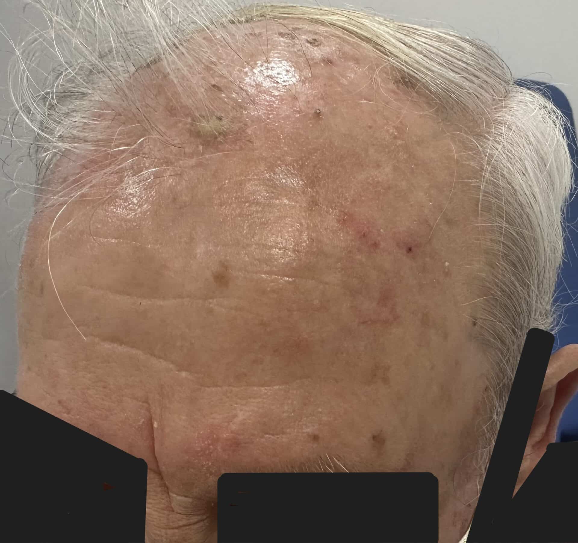 Multiple actinic keratoses on scalp. Photo Almirall SA