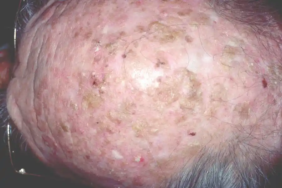 SCF AK Scalp 01 medium