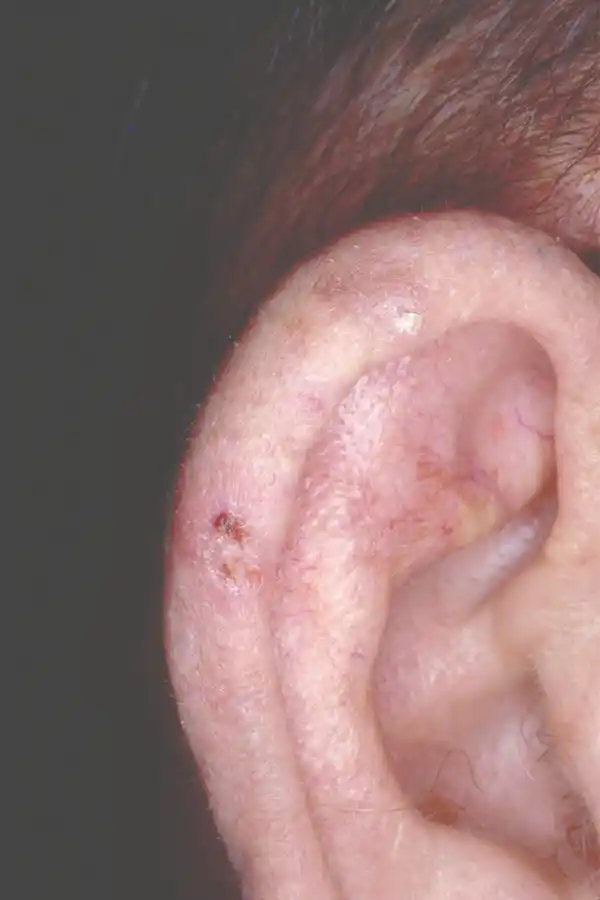 SCF Actinic keratosis on the ear