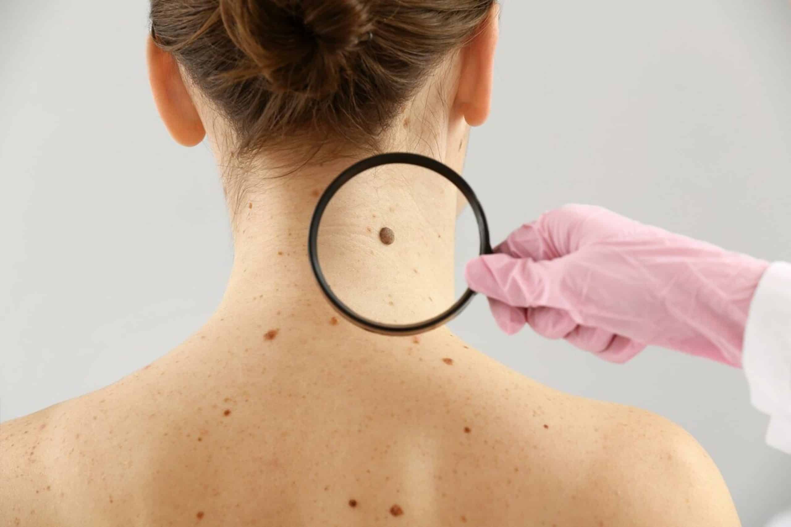 Skin Cancer Screening and Advanced Treatment in Ogden UT