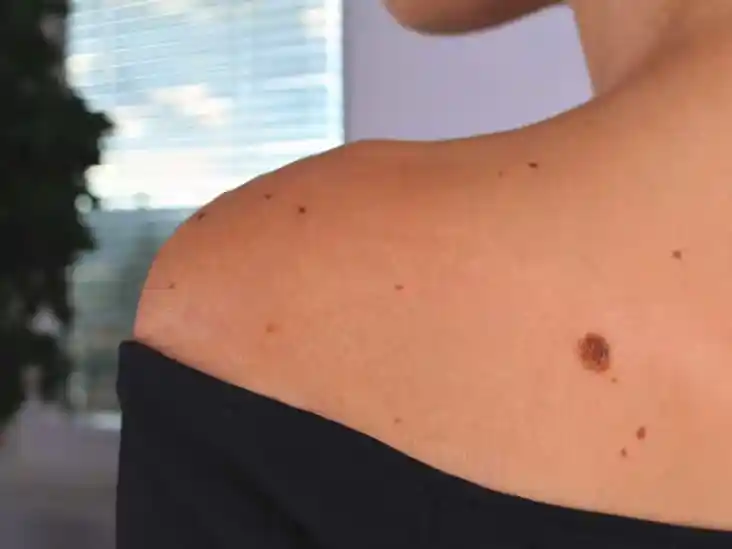 Dysplastic Nevus (1).1