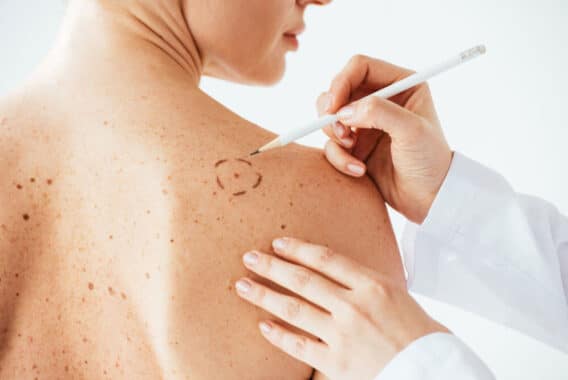 Premier dermatology partners skin cancer awareness month why you should never leave skin cancer untreated