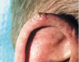 Squamous Cell Carcinoma 1 wart like on ear 304x240