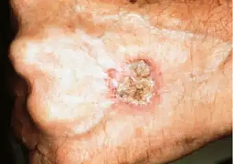 Squamous Cell Carcinoma 2 scaly patch on back of hand 340x240