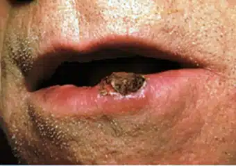 Squamous Cell Carcinoma 3 elevated growth on lip 340x240