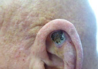 Squamous Cell Carcinoma open sore that bleeds 340x240