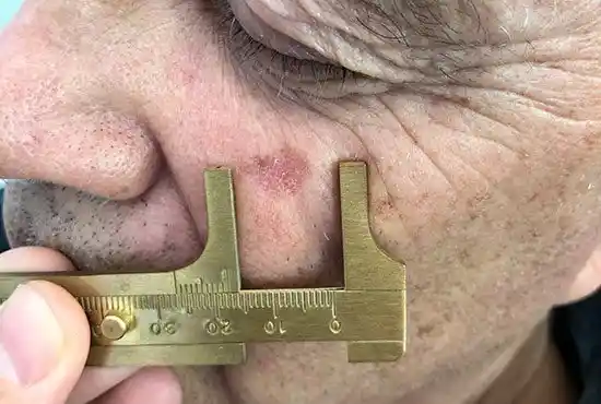 Actinic keratosis kelowna