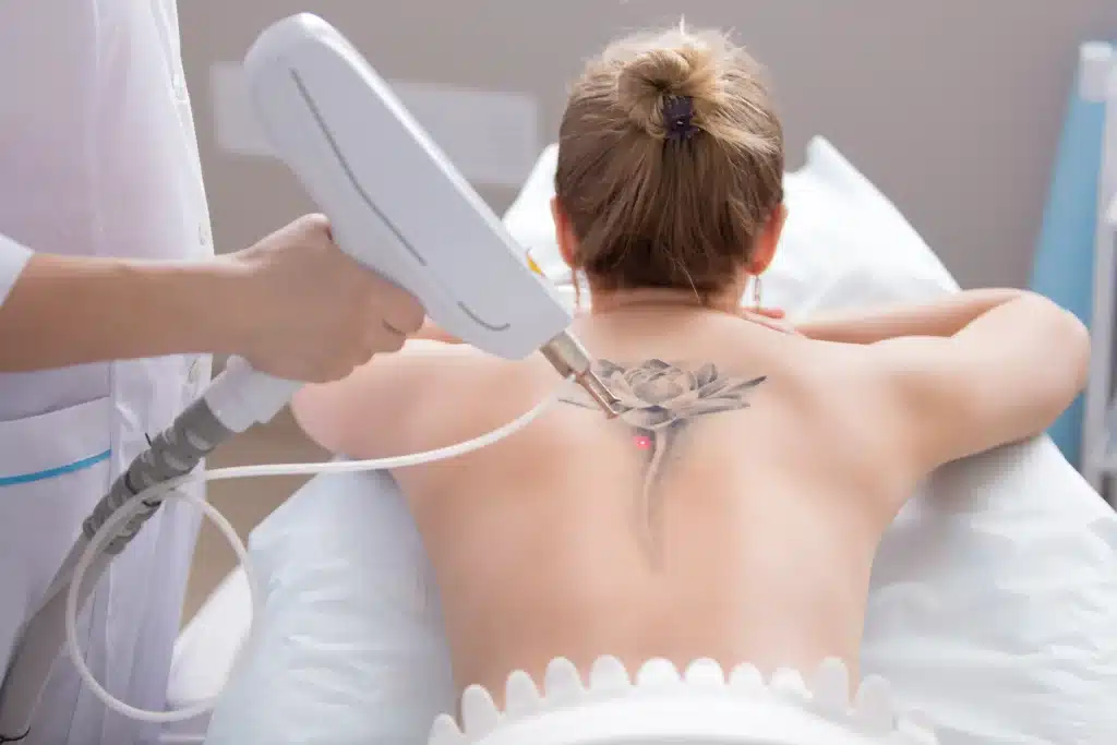 Remocao de tatuagem