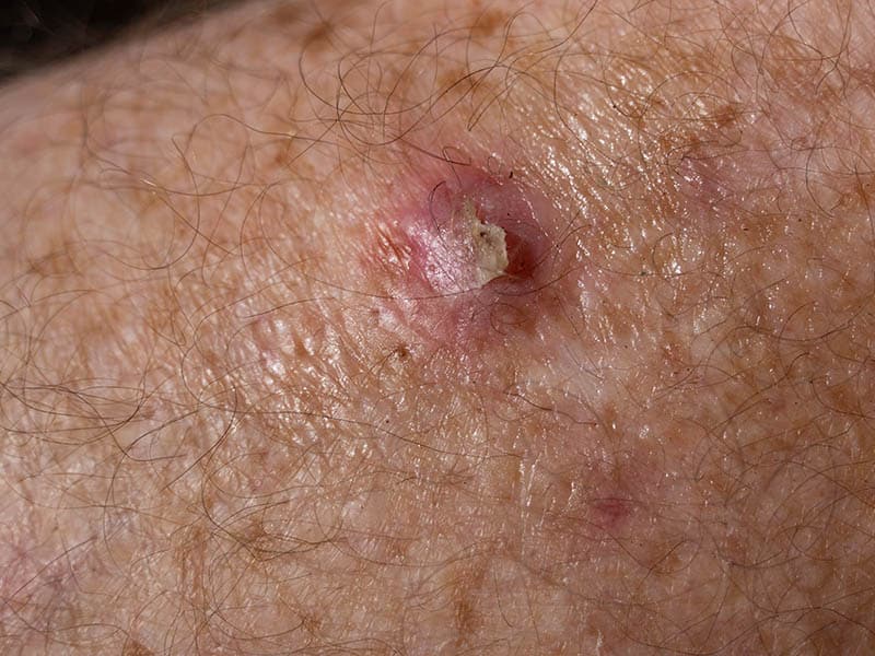 SCC or BCC skin cancer on senior males' leg waiting for surgery.