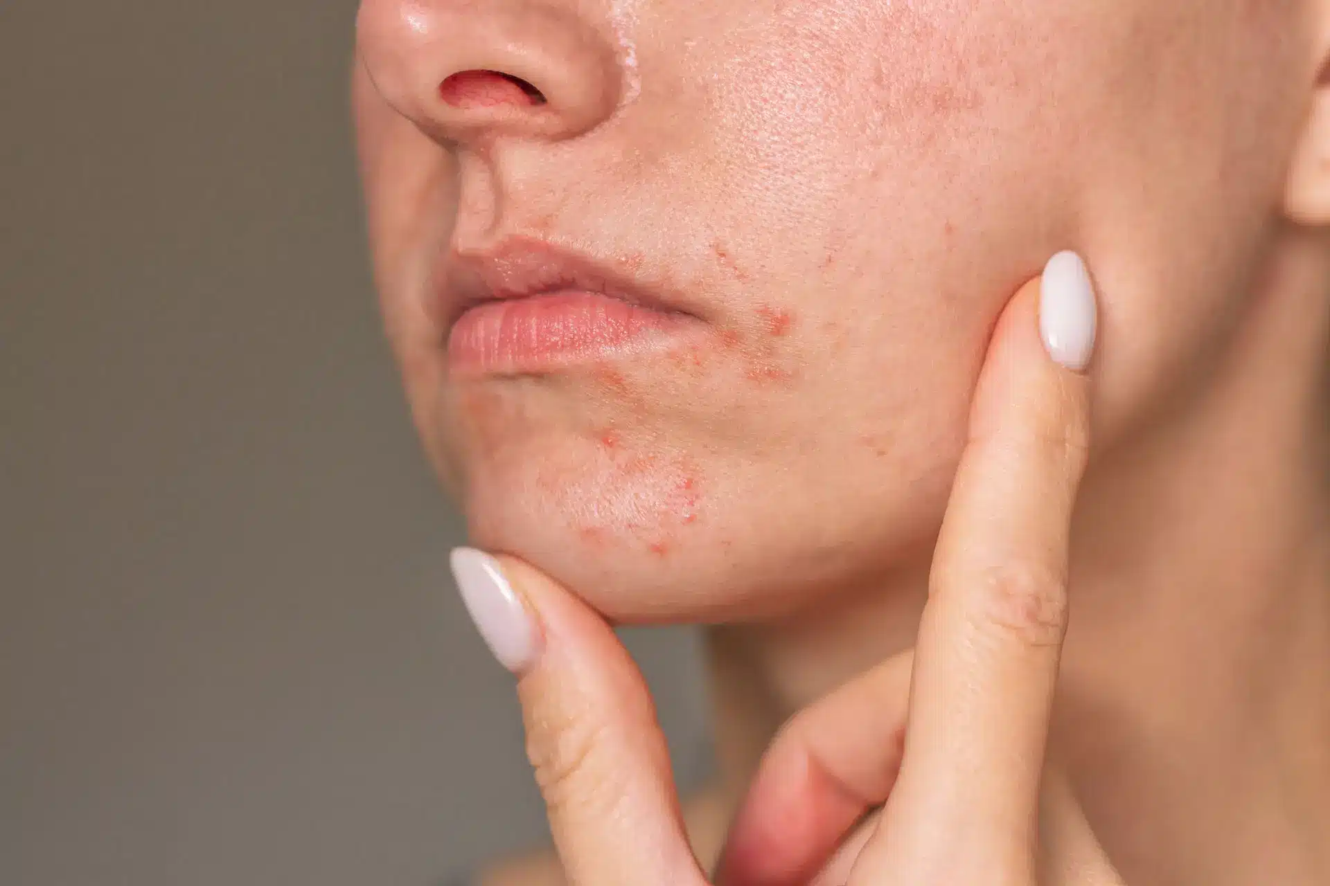 Allergy Patch Testing for Contact Dermatitis in Ogden UT