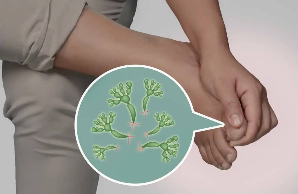 Fungal Infections