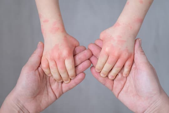 Diagnosis and Long-Term Relief for Chronic Dermatitis in Ogden UT