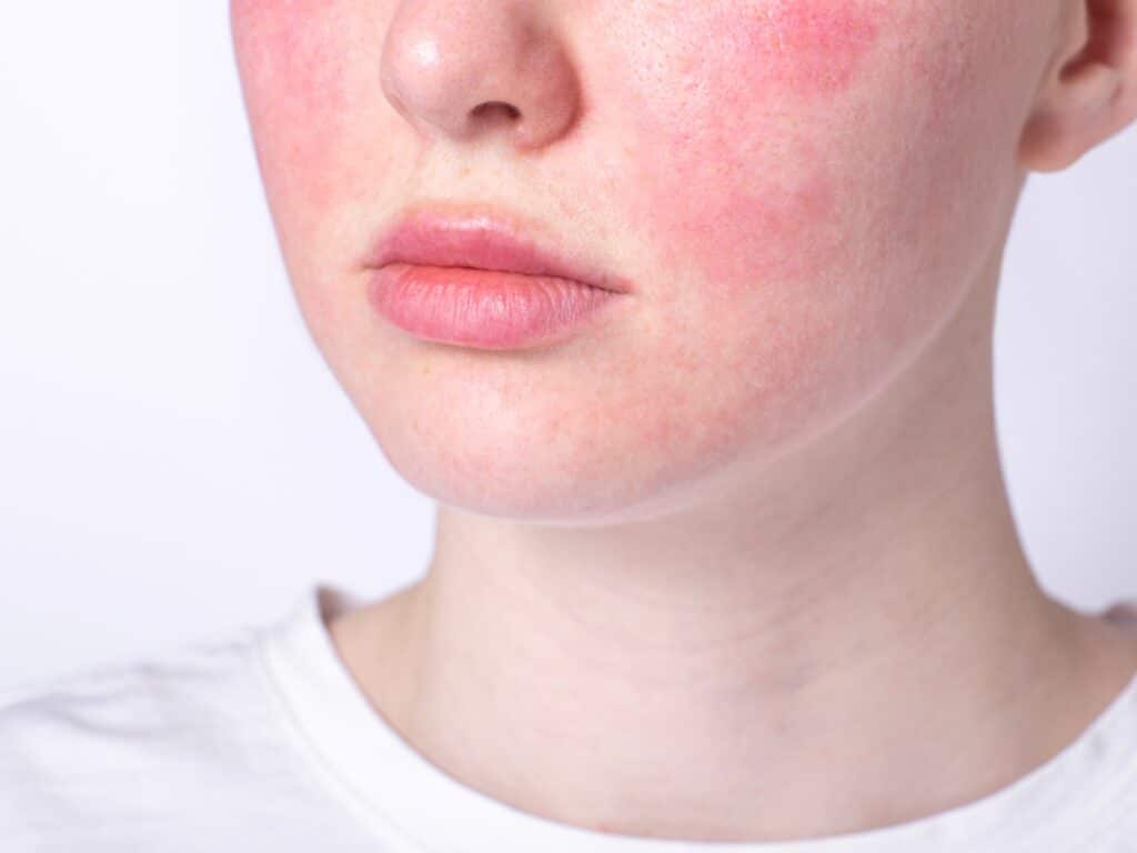 A young person with rosacea 1024x768