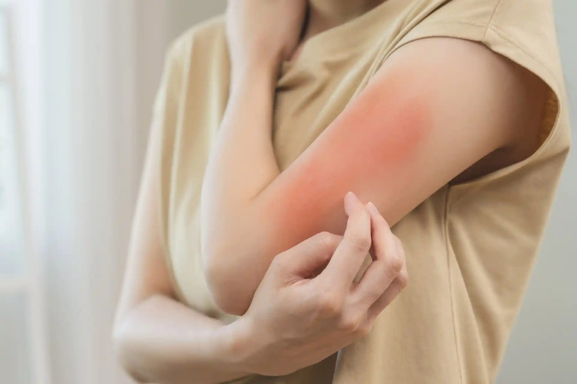 Rashes
