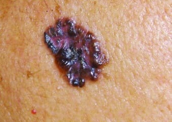 A pigmented basal cell carcinoma on skin of color