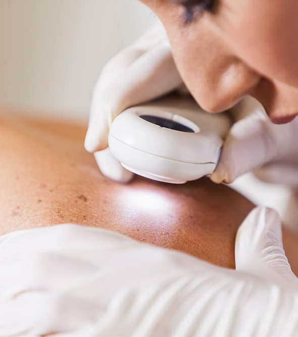 Melanoma (3)