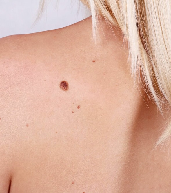 Melanoma (4)