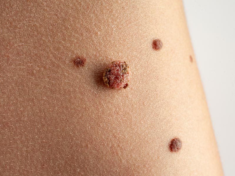 Melanoma (6)