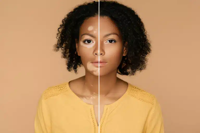 Skin Discoloration