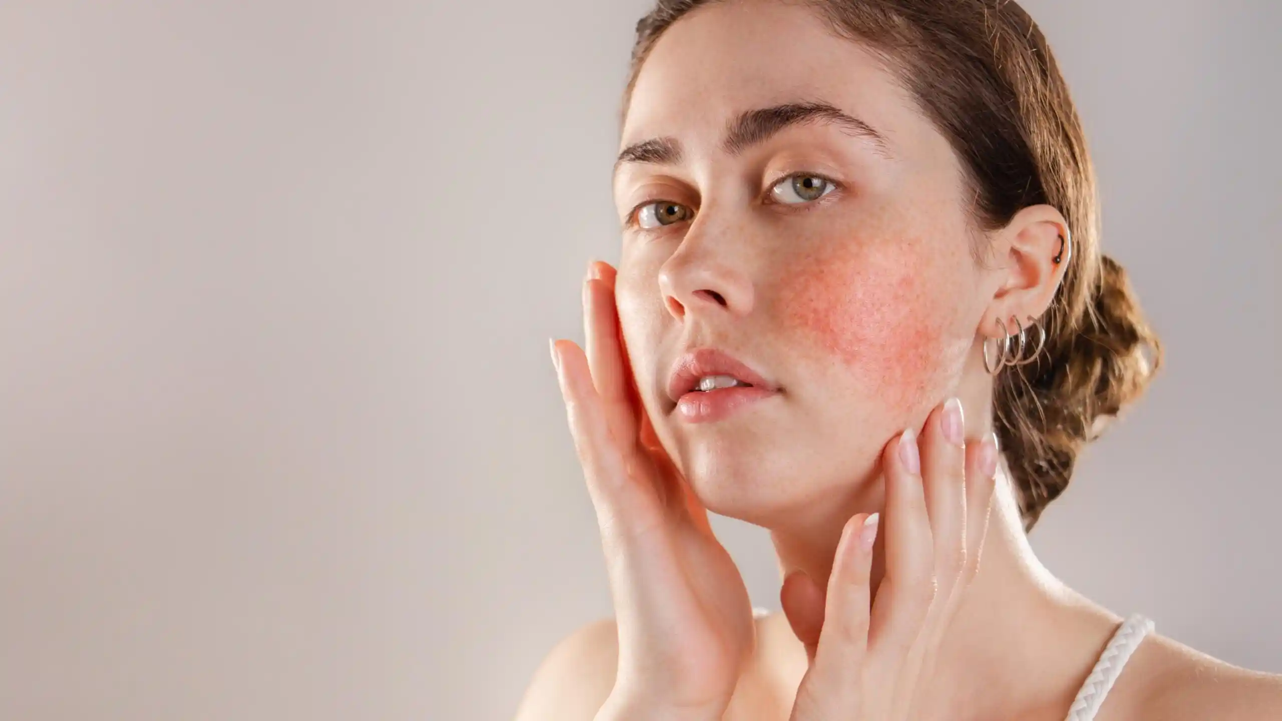 Rosacea