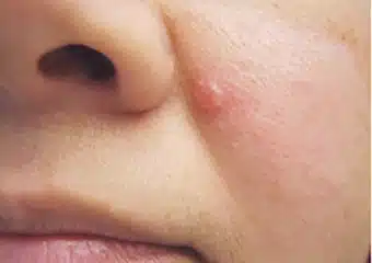 A shiny bump or nodule