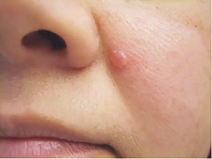 Basal cell carcinoma appearing as a shiny bump