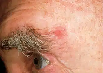 A reddish patch or irritated area