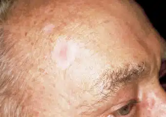 A scar-like area that is flat white, yellow or waxy in color