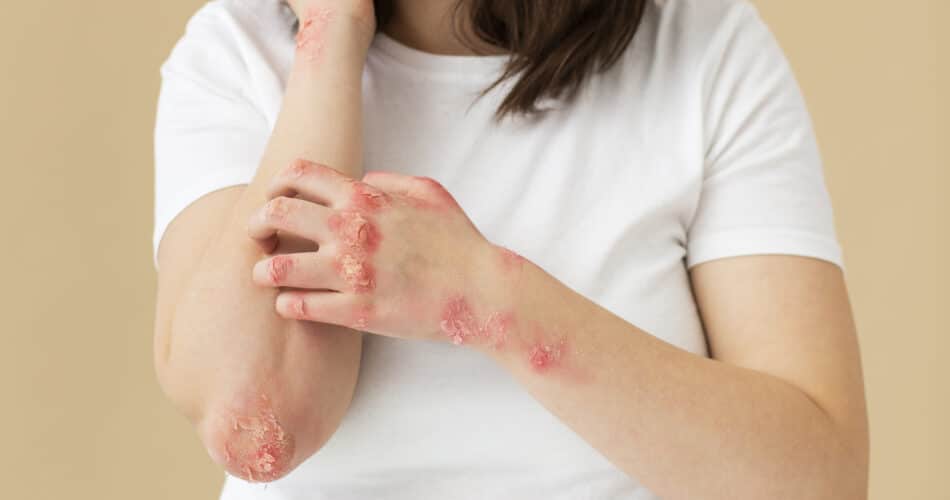 Targeted Treatment for Fungal Infections and Nail Clearance in Ogden UT