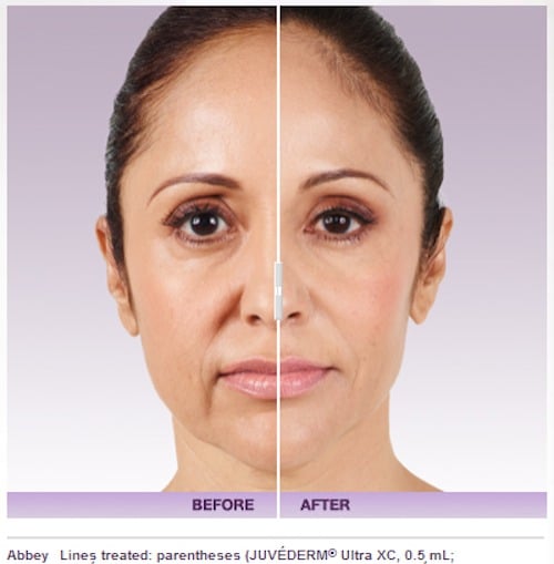 Juvederm