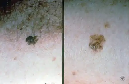 Melanoma that looks like an odd-shaped mole