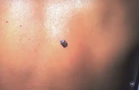 Melanoma that looks like a firm, raised growth
