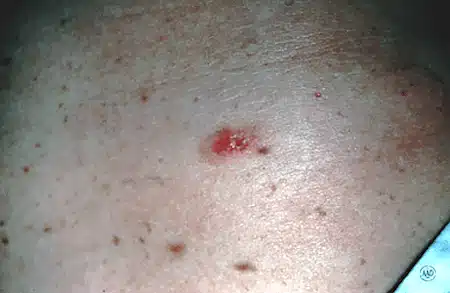 Melanoma that looks like a sore