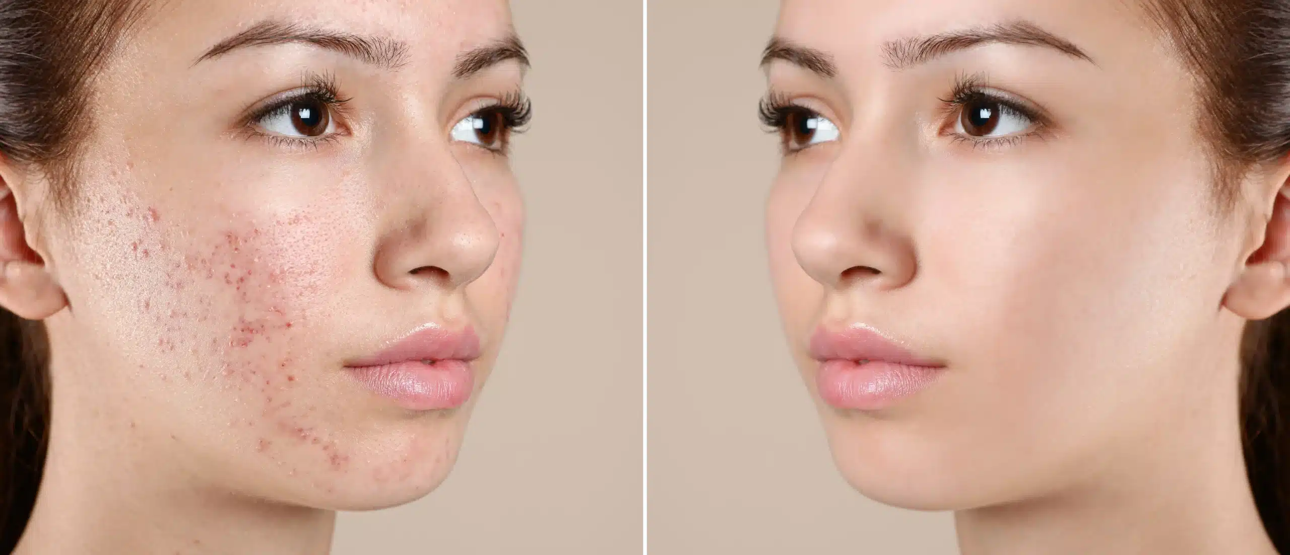 Dermatologist for Acne Scars in Kaysville & Ogden, UT