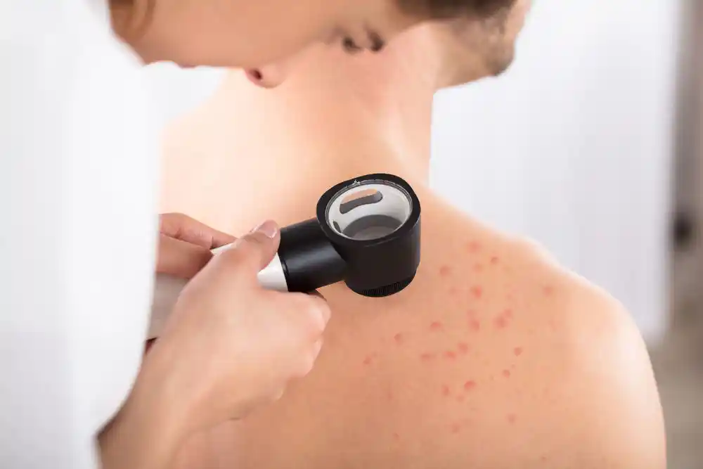 Eczema