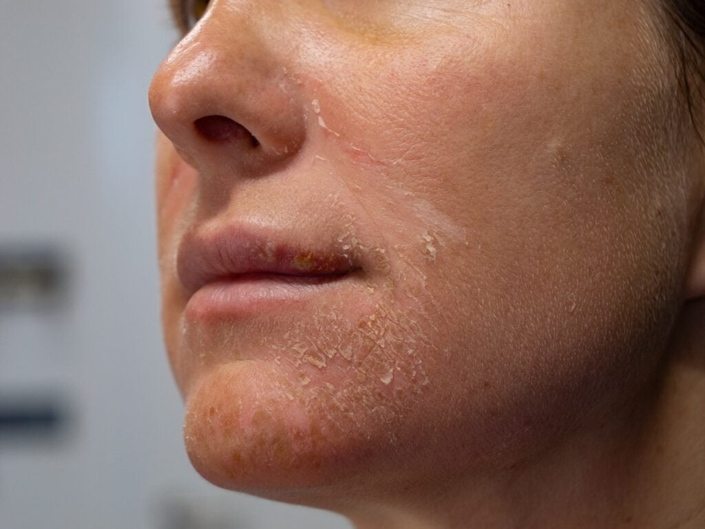 Sun-damaged skin with rough actinic keratosis patches